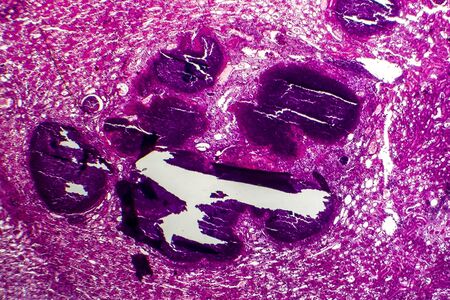 Histopathology of acute nephritis, light micrograph, photo under microscope