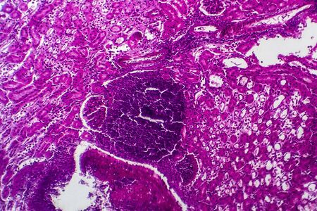 Histopathology of acute nephritis, light micrograph, photo under microscope
