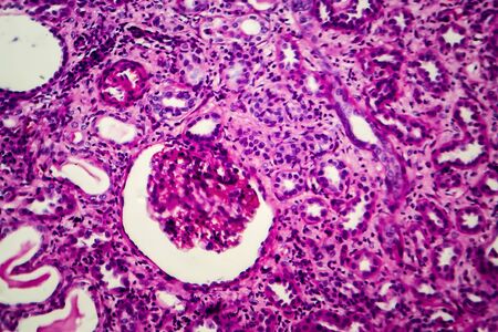 Chronic pyelonephritis, light micrograph, photo under microscopeの写真素材
