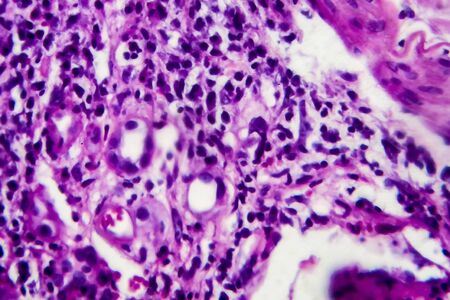 Histopathology of interstitial nephritis, light micrograph, photo under microscopeの写真素材