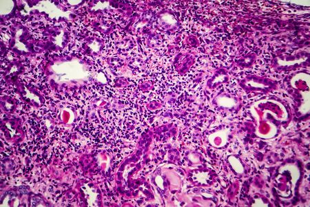 Chronic pyelonephritis, light micrograph, photo under microscopeの写真素材