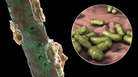 Human hair with dandruff and close-up view of microscopic fungi Malassezia furfur that cause...