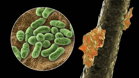 Human hair with dandruff and close-up view of microscopic fungi Malassezia furfur that cause...