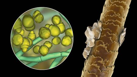 Human hair with dandruff and close-up view of microscopic fungi Malassezia furfur that cause...
