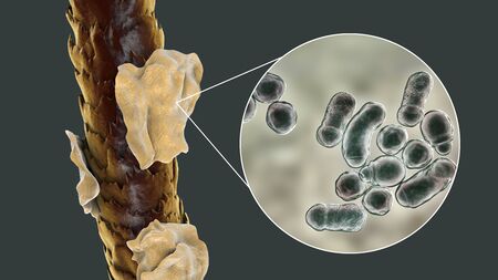 Human hair with dandruff and close-up view of microscopic fungi Malassezia furfur that cause...