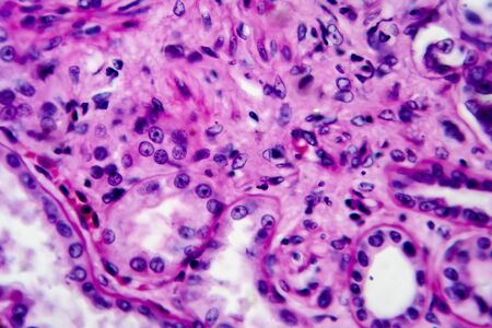 Chronic pyelonephritis, light micrograph, photo under microscope. High magnificationの写真素材