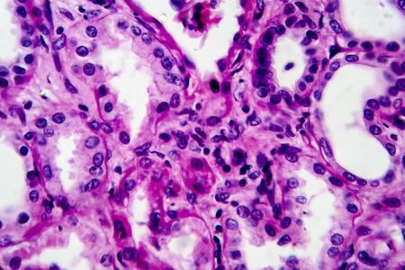 Chronic pyelonephritis, light micrograph, photo under microscope. High magnification
