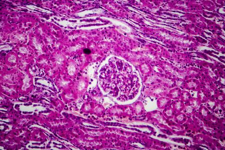 Acute pyelonephritis, light micrograph, photo under microscopeの写真素材