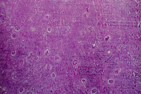 Chronic glomerulonephritis, light micrograph, photo under microscopeの写真素材