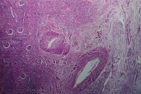 Chronic glomerulonephritis, light micrograph, photo under microscope