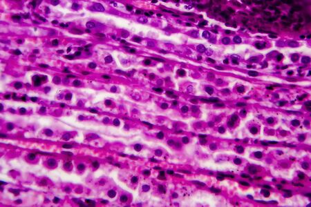 Acute pyelonephritis, light micrograph, photo under microscope. High magnificationの写真素材