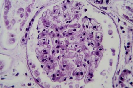 Acute glomerulonephritis, light micrograph, photo under microscope. High magnificationの写真素材