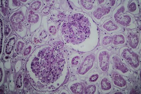 Acute glomerulonephritis, light micrograph, photo under microscope