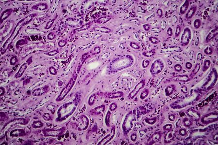Diffuse proliferative glomerulonephritis, DPGN, light micrograph, photo under microscope