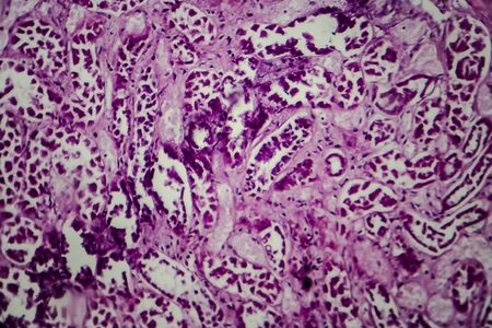 Histopathology of diffuse sclerosing glomerulonephritis, light micrograph, photo under microscopeの写真素材