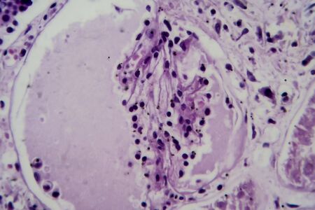 Acute glomerulonephritis, light micrograph, photo under microscope. High magnification
