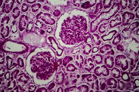 Histopathology of diffuse sclerosing glomerulonephritis, light micrograph, photo under microscopeの写真素材