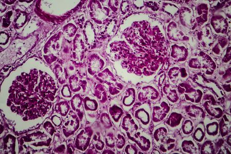 Histopathology of diffuse sclerosing glomerulonephritis, light micrograph, photo under microscopeの写真素材