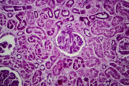 Diffuse proliferative glomerulonephritis, DPGN, light micrograph, photo under microscopeの写真素材