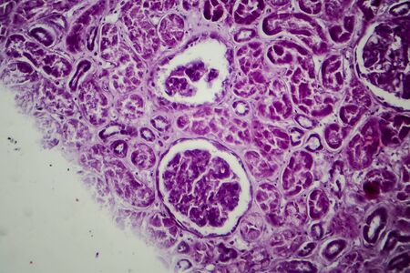 Diffuse proliferative glomerulonephritis, DPGN, light micrograph, photo under microscope