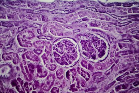 Diffuse proliferative glomerulonephritis, DPGN, light micrograph, photo under microscopeの写真素材