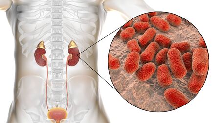 Acute pyelonephritis caused by bacteria Acinetobacter baumannii, medical concept, 3D illustration