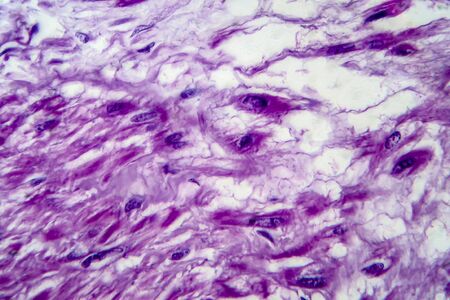 Uterine leiomyoma, also known as fibroids,a benign smooth muscle tumor of the uterus, light micrograph, photo under microscopeの写真素材