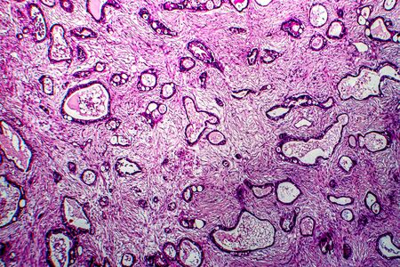 Uterine cancer, light micrograph, photo under microscope