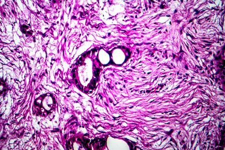 Uterine cancer, light micrograph, photo under microscope
