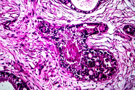 Uterine cancer, light micrograph, photo under microscope