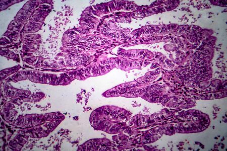 Endometrial adenocarcinoma, light micrograph, photo under microscope