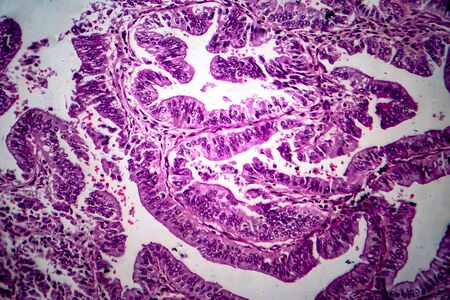 Endometrial adenocarcinoma, light micrograph, photo under microscope