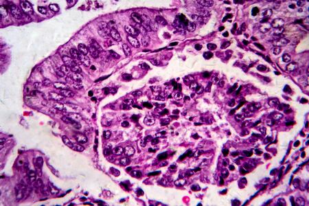 Endometrial adenocarcinoma, light micrograph, photo under microscope
