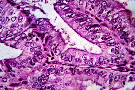 Endometrial adenocarcinoma, light micrograph, photo under microscopeの写真素材
