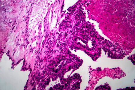 Papillary serous ovarian adenocarcinoma, cancer of ovary, light micrograph, photo under microscopeの写真素材