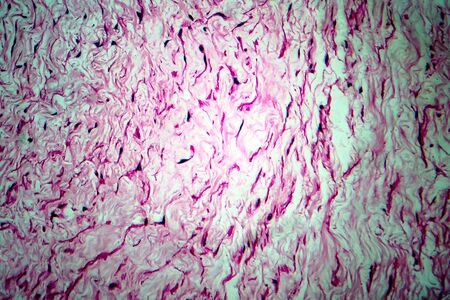 Ovarian cyst, light micrograph, photo under microscope