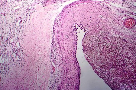 Ovarian cyst, light micrograph, photo under microscopeの写真素材