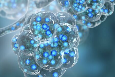 Coronavirus pneumonia, alveoli filled with Covid-19 Novel  coronavirus, 2019-nCoV, 3D illustration