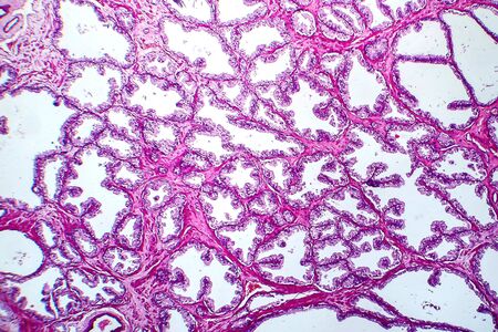 Prostate cancer, light micrograph, photo under microscopeの写真素材