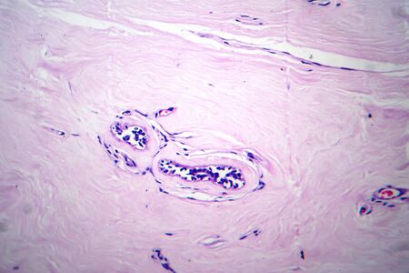 Uterus adenofibroma, light micrograph, photo under microscope. A rare benign tumor of the uterus...