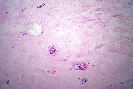 Uterus adenofibroma, light micrograph, photo under microscope. A rare benign tumor of the uterus...
