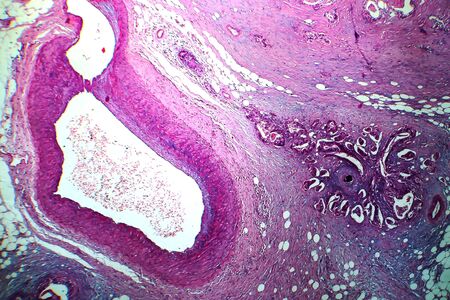 Breast cancer, light micrograph, photo under microscopeの写真素材