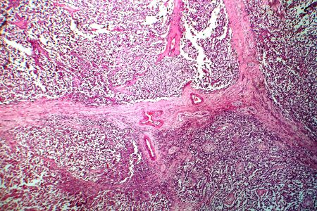 Testicular seminoma, light micrograph, photo under microscope. A most common germ cell tumor of the testisの写真素材