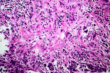 Breast ductal carcinoma, light micrograph, photo under microscopeの写真素材