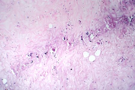 Breast fibroadenosis, light micrograph, photo under microscope. Common benign hyperplastic process...