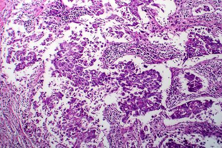 Breast ductal carcinoma, light micrograph, photo under microscopeの写真素材