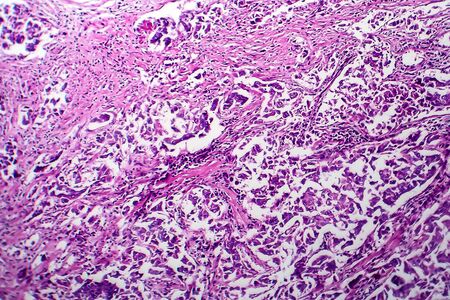 Breast ductal carcinoma, light micrograph, photo under microscopeの写真素材