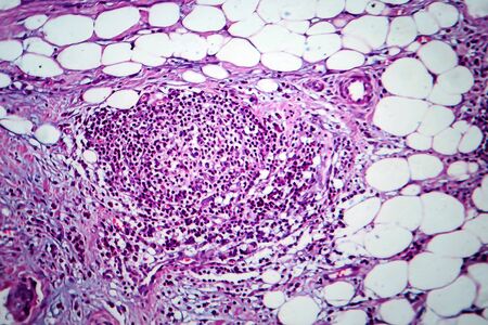 Breast cancer, light micrograph, photo under microscopeの写真素材