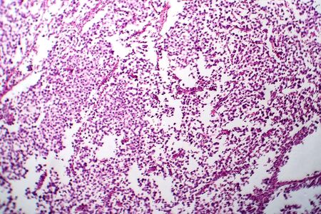 Testicular seminoma, light micrograph, photo under microscope. A most common germ cell tumor of the testisの写真素材