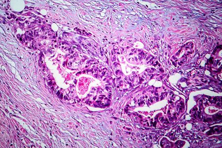 Breast cancer, light micrograph, photo under microscopeの写真素材